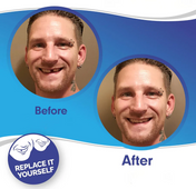 Dental Veneer Kit with Upper and Lower Covers 1